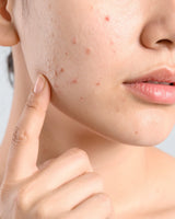 Clearer Skin Starts Here: The Doctor-Led Skincare Routine for Acne-Prone Skin
