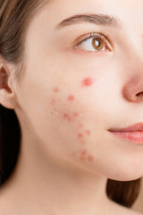 How to Treat Acne Effectively: A Doctor-Led 360° Approach to Clearer Skin