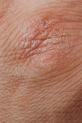 October is Eczema Awareness Month: Understanding and Supporting Those Living with Eczema