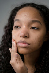 Hormonal Acne vs Regular Acne: How to Tell the Difference