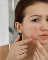 What Is a Retinol Purge? How Long It Lasts and How to Manage It