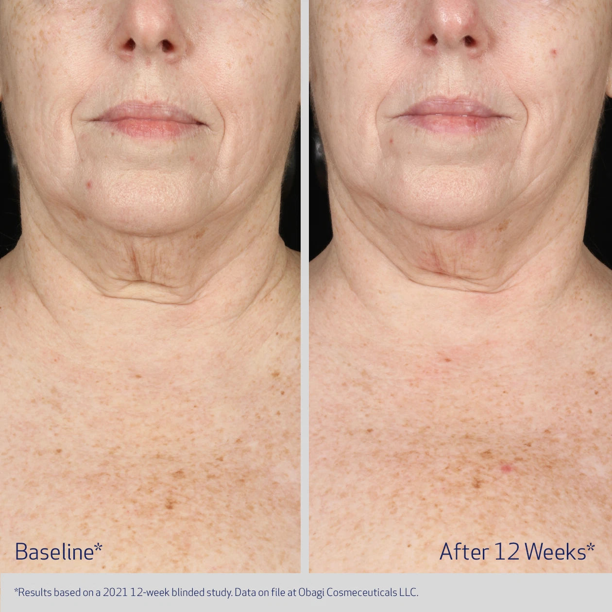 Obagi Medical ELASTIderm Neck and Decollete Concentrate 60ml