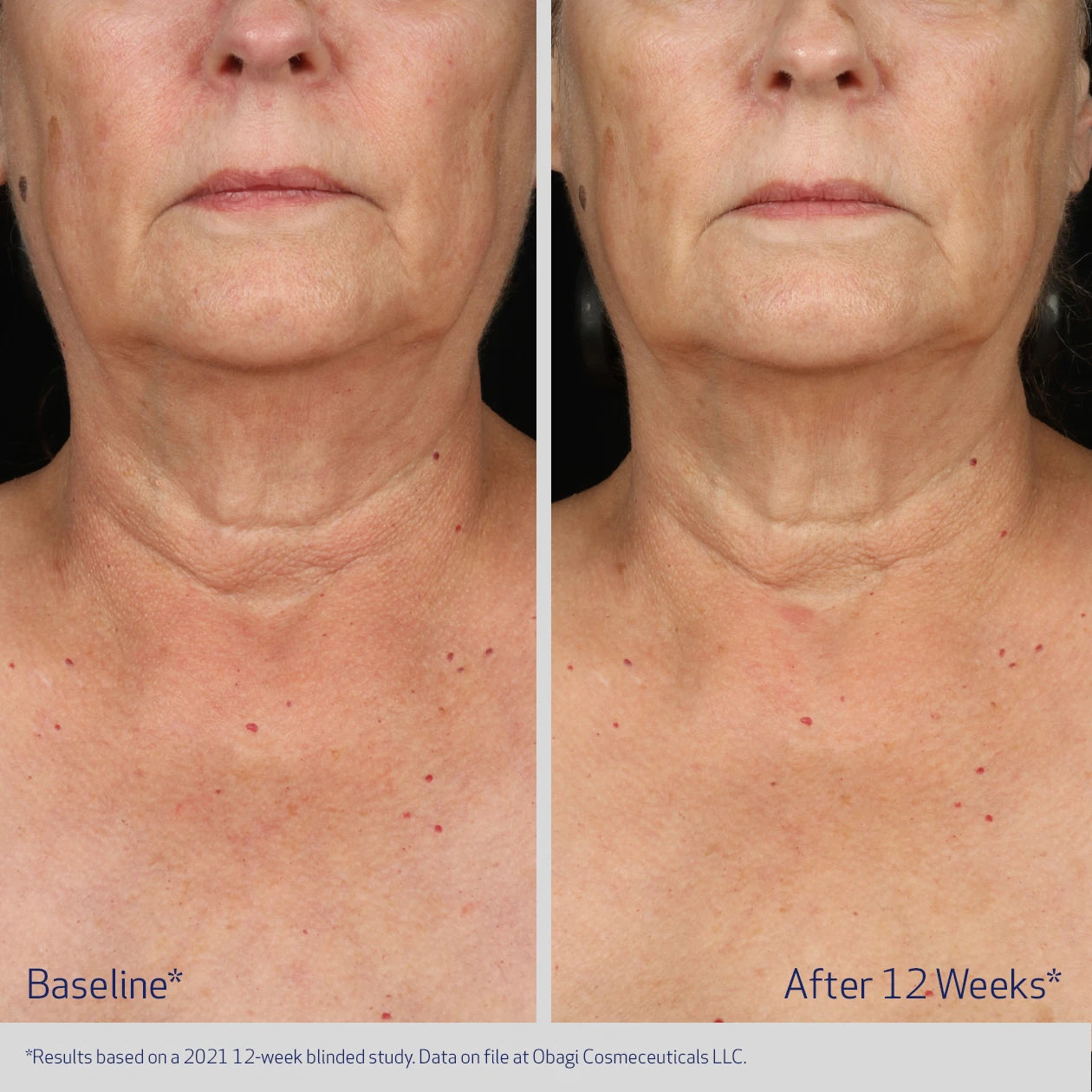 Obagi Medical ELASTIderm Neck and Decollete Concentrate 60ml