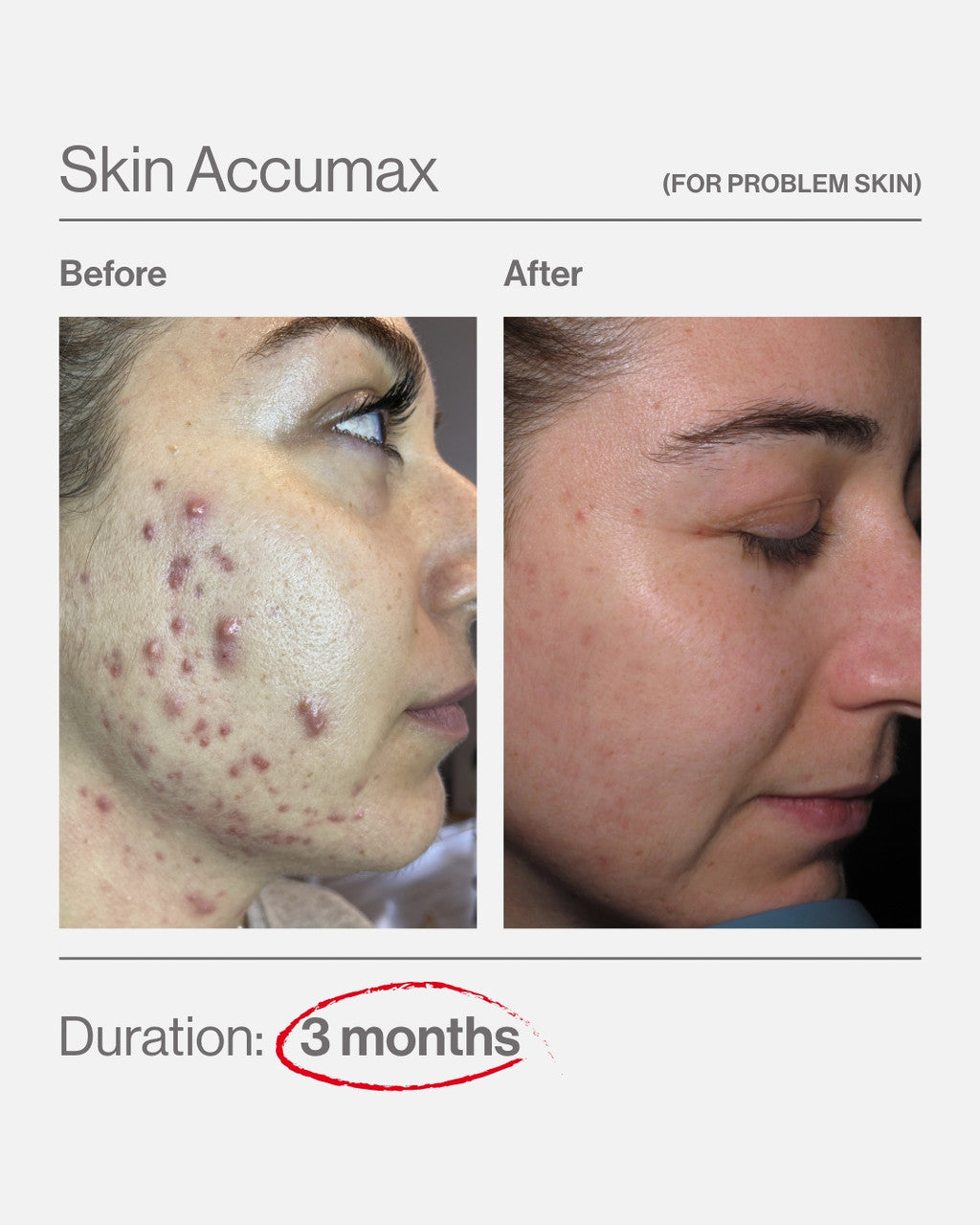 Skin Accumax - Targets Problem Skin