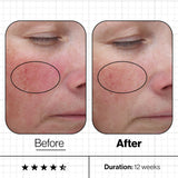 Skin Even IQ - Targets Stubborn Pigmentation